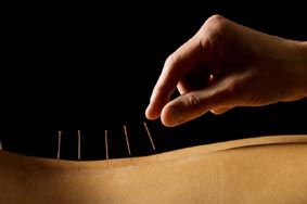 l'acupuncture anti stress